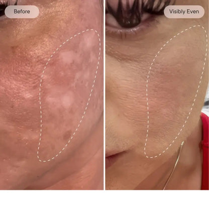 Rejuvenate the look of dull skin with the Micro-Infusion Facial System