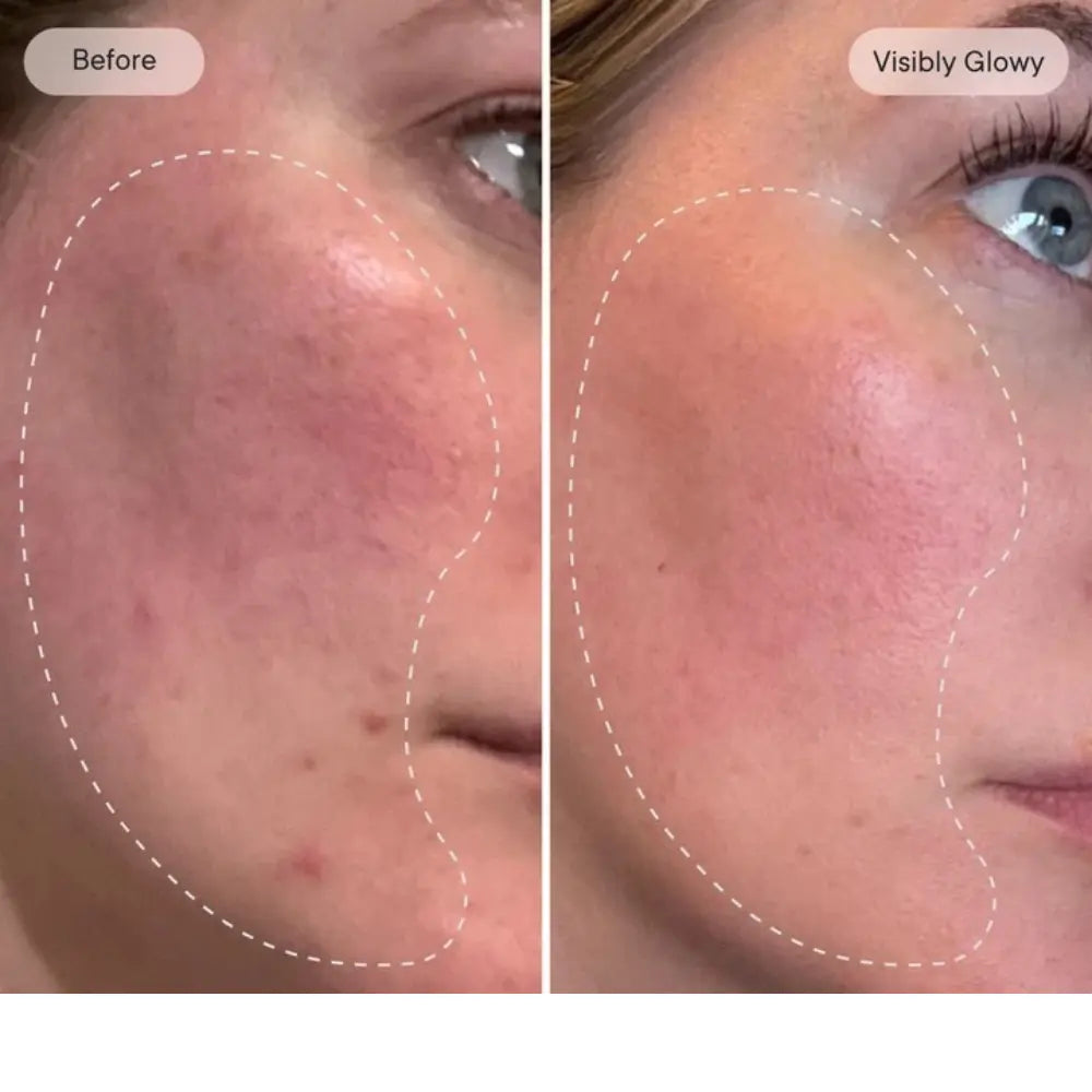 Rejuvenate the look of dull skin with the Micro-Infusion Facial System